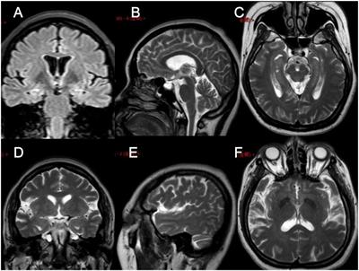 A PIK3R2 Mutation in Familial Temporal Lobe Epilepsy as a Possible Pathogenic Variant